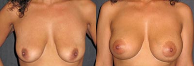 Breast augmentation