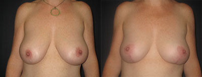 Breast reduction
