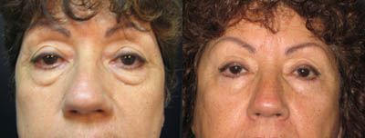 Eyelid