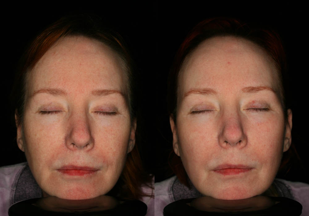 MixTo CO2 Laser